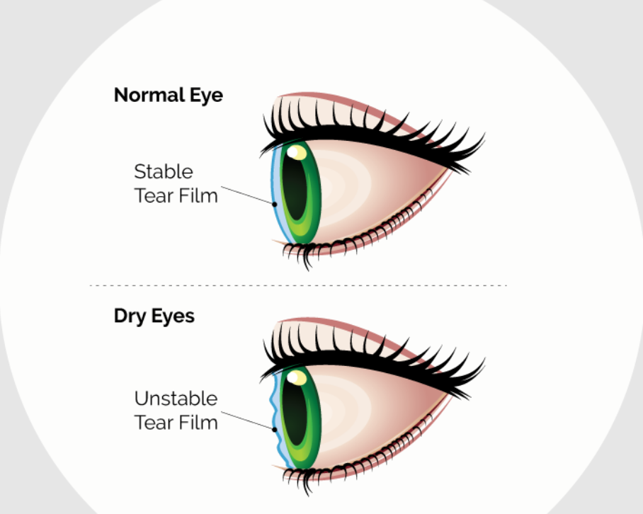 Lensweets How To Manage Dry Eye While Wearing Contact Lenses Milled