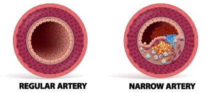 Regular artery vs Narrow artery