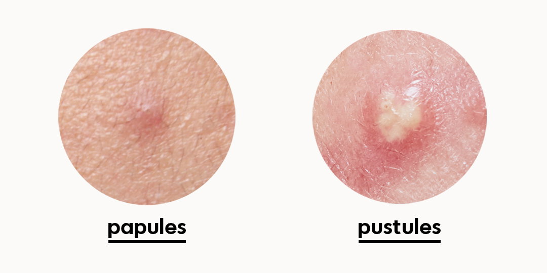 A Comprehensive Guide To Acne