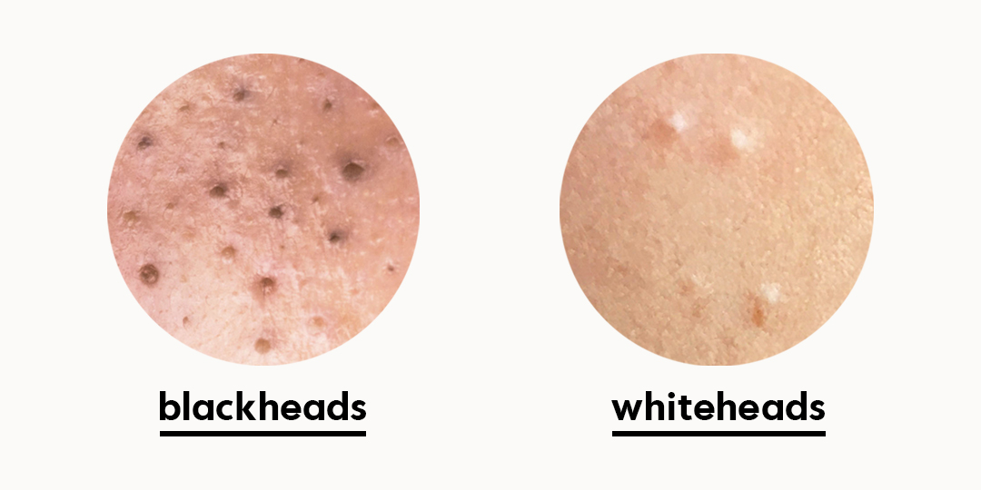 SLMD Skincare Blackheads, Whiteheads, Papules, Pustules... Milled