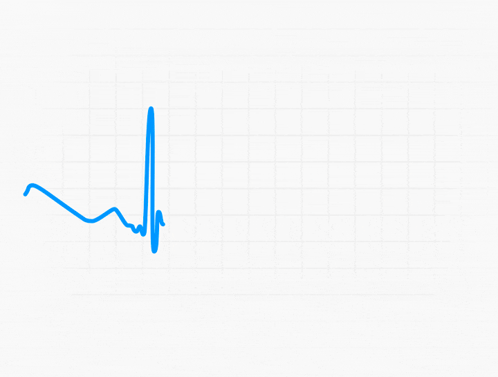 ECG