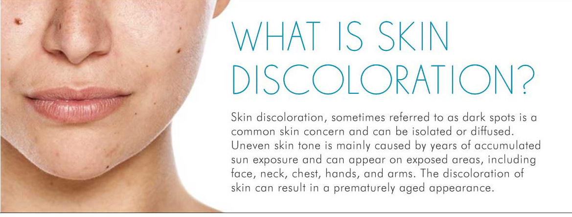 Skinceuticals: What is Skin Discoloration? | Milled