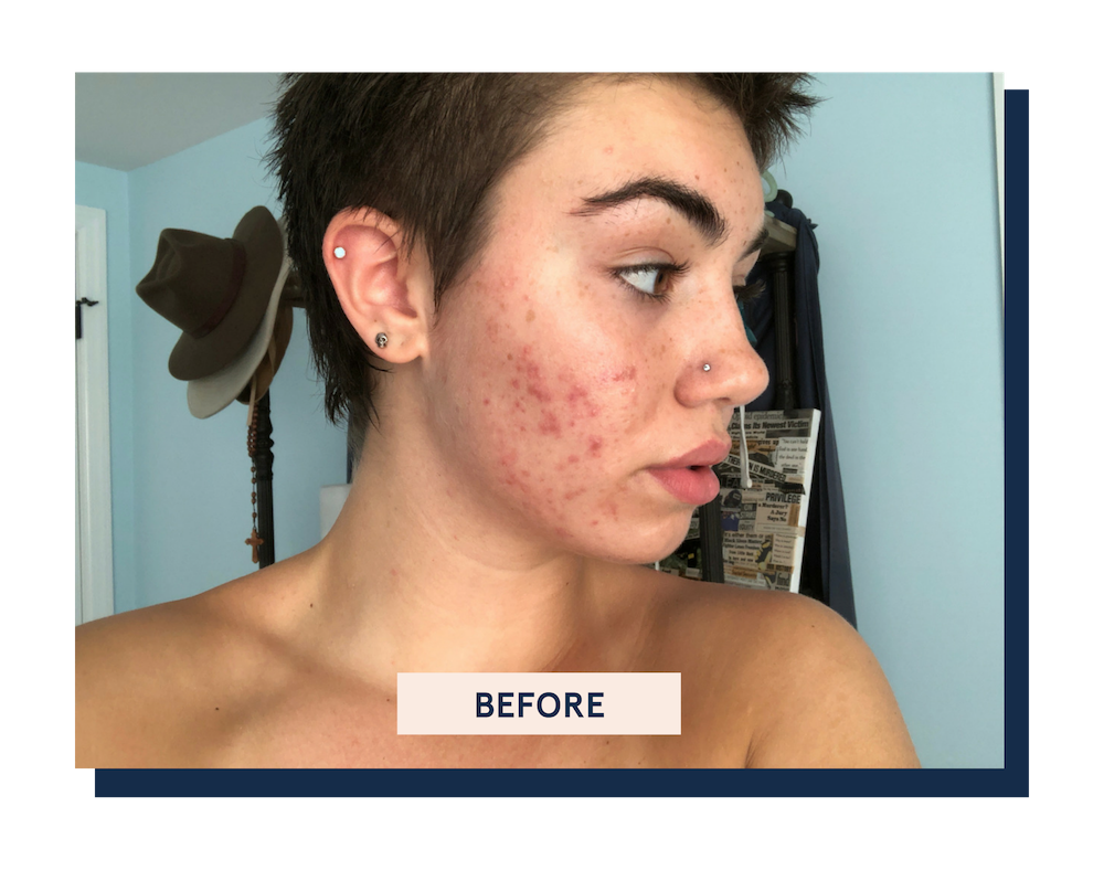 blume meltdown cystic acne