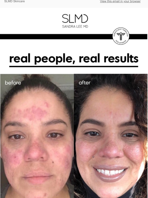 slmd sensitive skin acne system