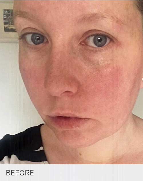 augustinus bader rosacea