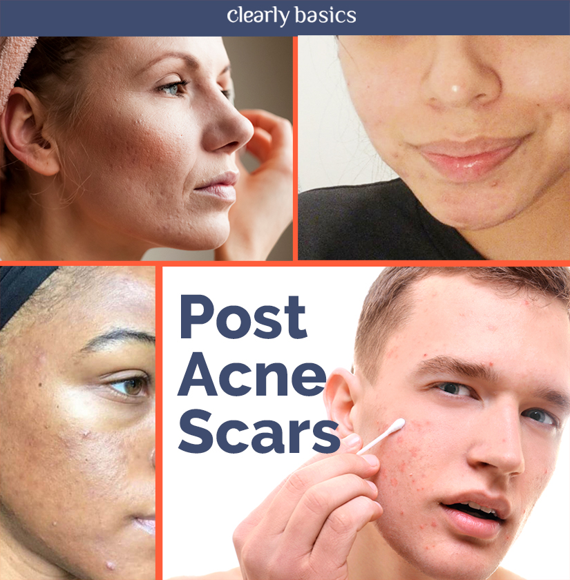 Clearly Basics: Fading, Soothing And Diminishing Scars | Milled