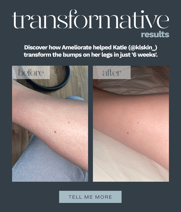 Transformative Results - discover how Ameliorate helped Katie transform her legs in just 6 weeks