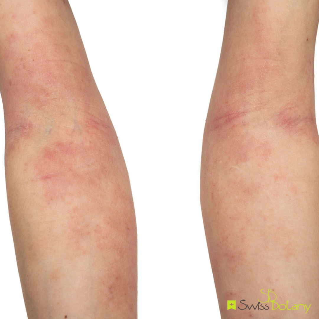 Swiss Botany: What is exactly is causing heat rashes this summer? | Milled