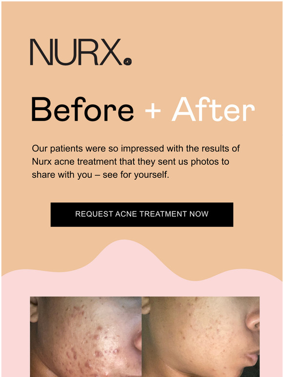 nurx-see-for-yourself-before-after-nurx-acne-treatment-milled