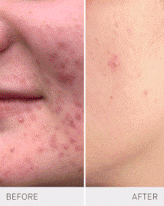 Acne
