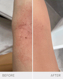 Eczema
