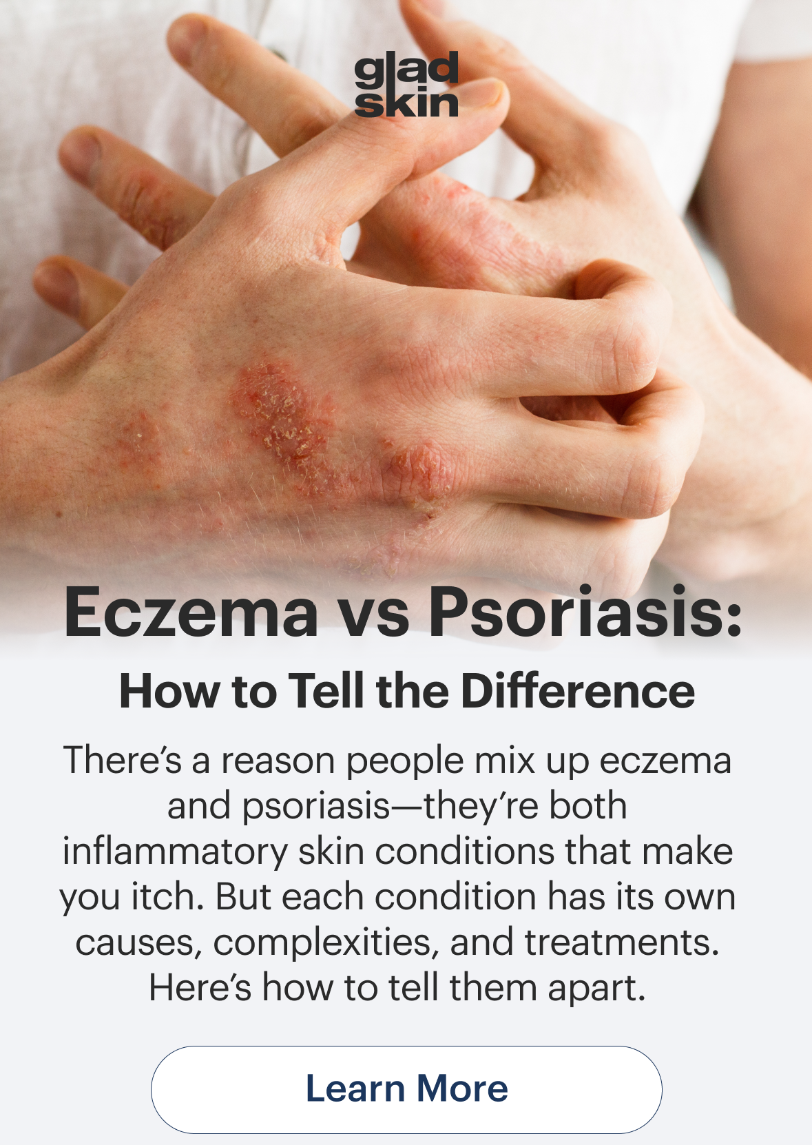 Gladskin: Eczema Vs Psoriasis: How To Tell The Difference | Milled