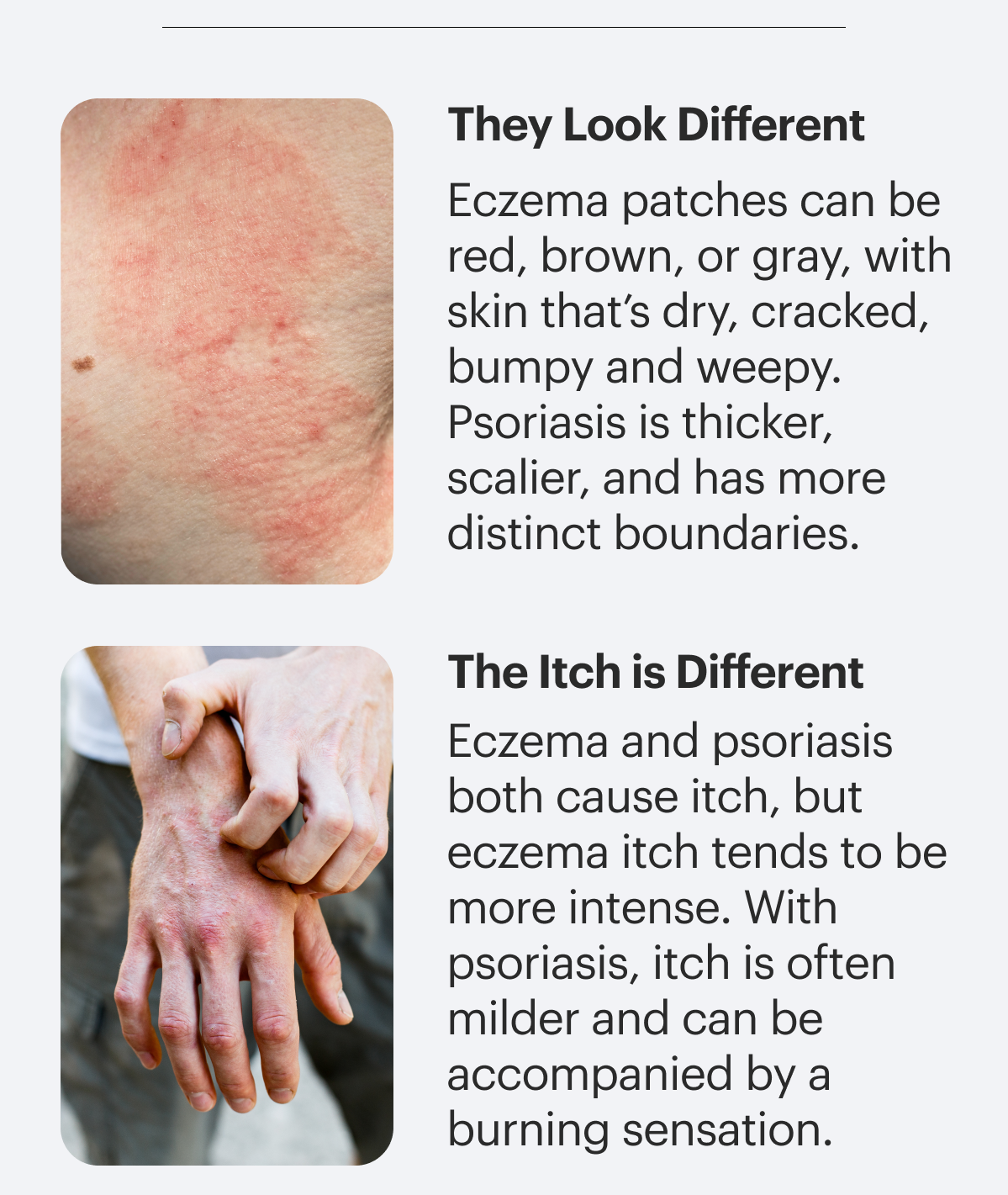 They look different. Eczema patches can be red, brown, or gray, with skin that’s dry, cracked, bumpy and weepy. Psoriasis is thicker, scalier, and has more distinct boundaries. The itch is different. Eczema and psoriasis both cause itch, but eczema itch tends to be more intense. With psoriasis, itch is often milder and can be accompanied by a burning sensation. 