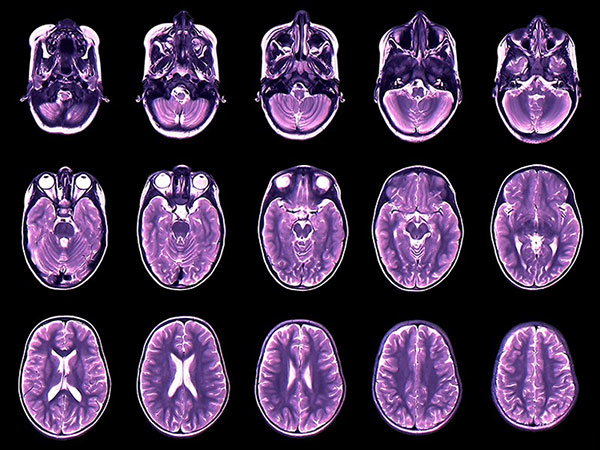 Coloured magnetic resonance imaging (MRI) scans in axial section.