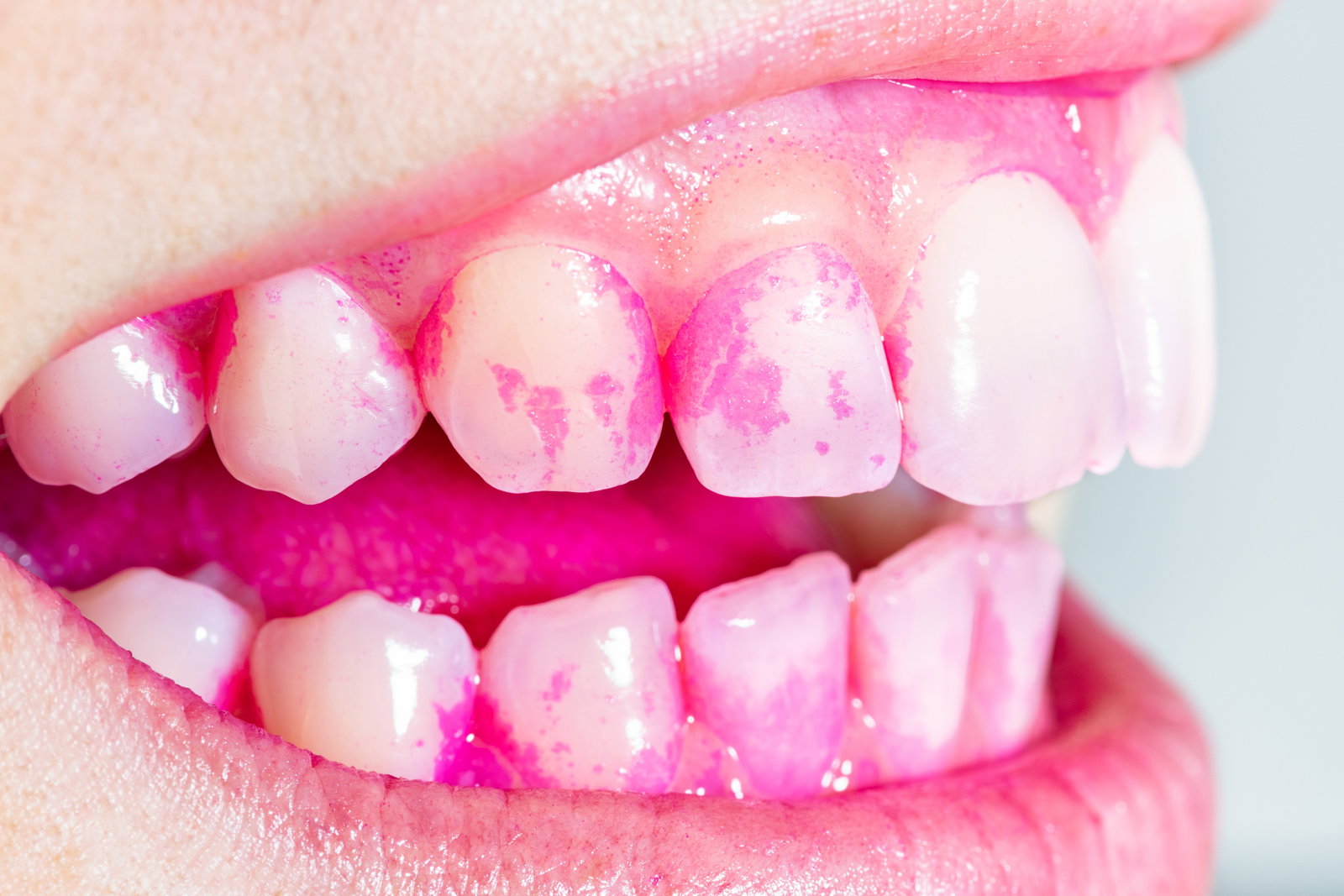 Teeth with pink plaque highlighters
