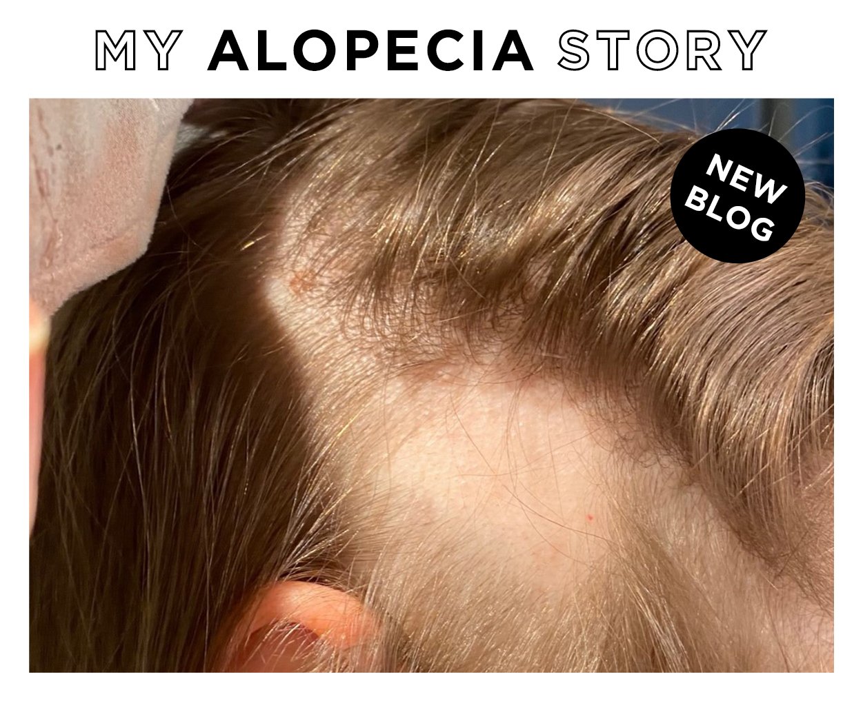 My alopecia story blog