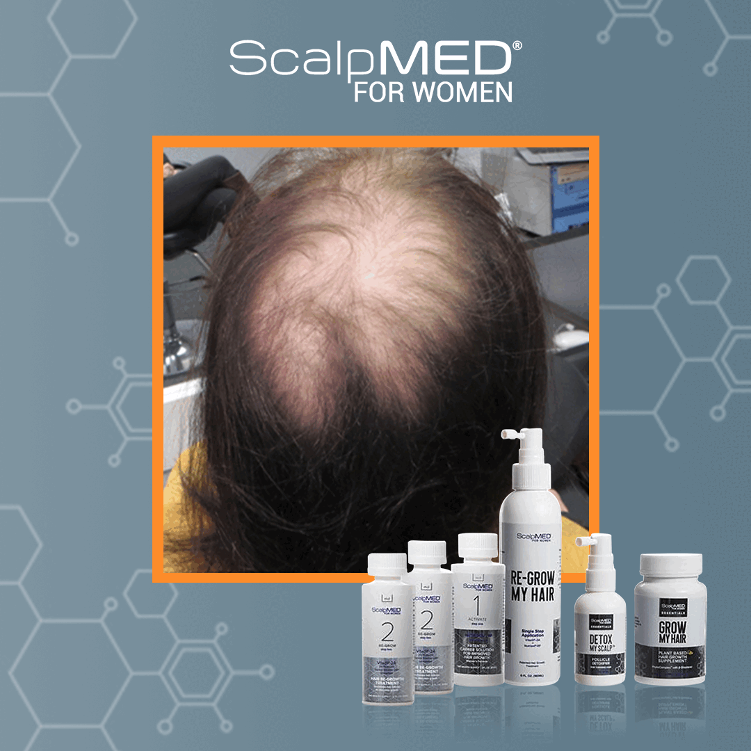 ScalpMED: Hair Regrowth Systems THAT WORK For BOTH Men & Women | Milled