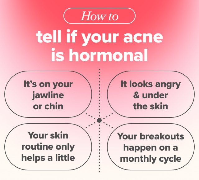 How to tell if your acne is hormonal - it's on your jawline or chin, it looks angry & under the skin, your skin routine only helps a little, your breakouts happen on a monthly cycle