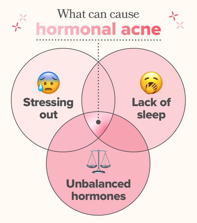 What can cause hormonal acne? Stressing out, lack of sleep, or unbalanced hormones