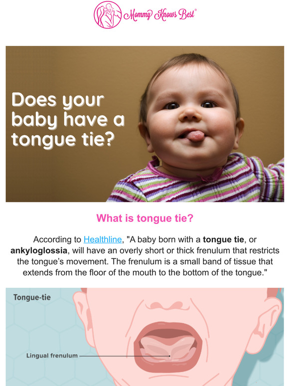 Does your baby have a tongue tie?