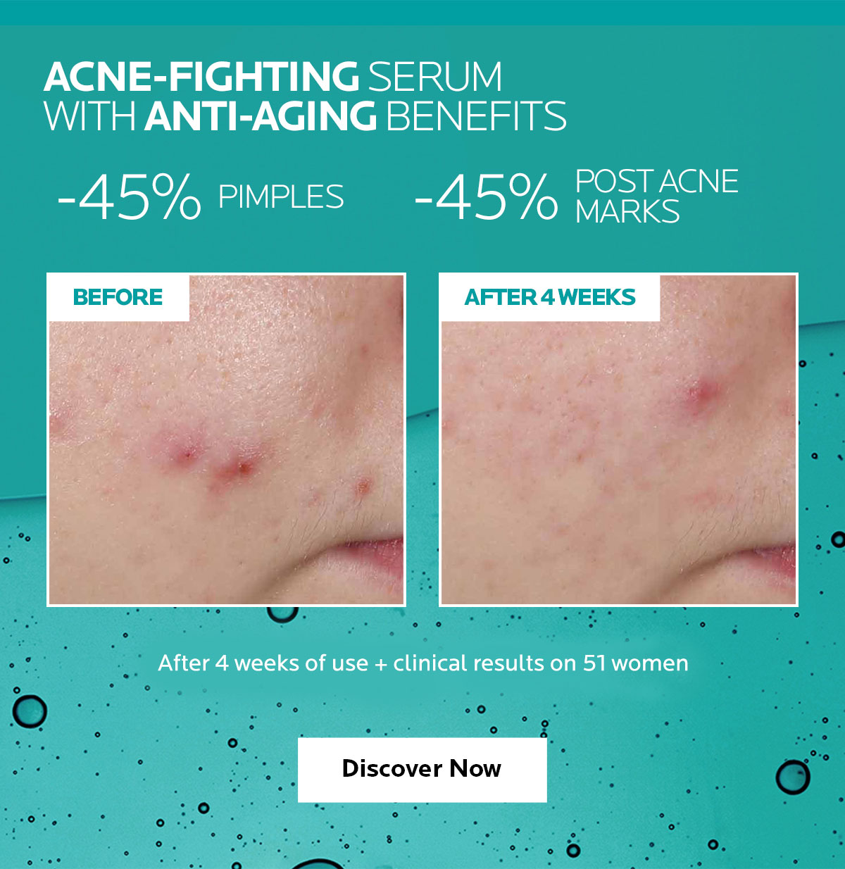 La Roche Posay Introducing Effaclar Salicylic Acid Acne Treatment Serum Milled