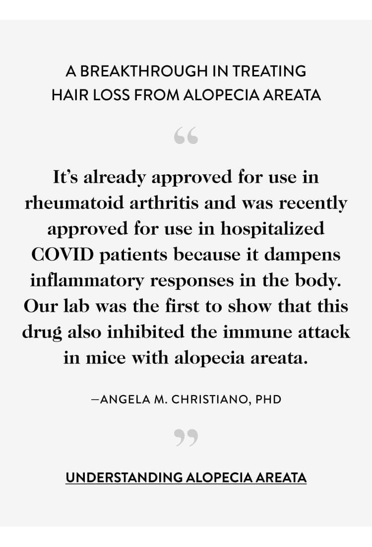 A Breakthrough in Treating Hair Loss from Alopecia Areata