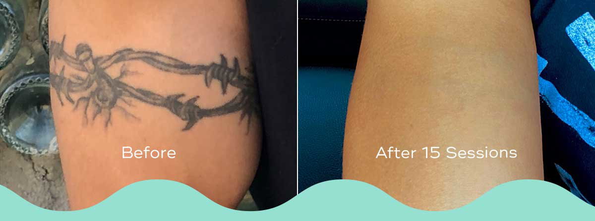 THE BEST 10 Tattoo Removal in Santa Barbara CA  Last Updated September  2023  Yelp