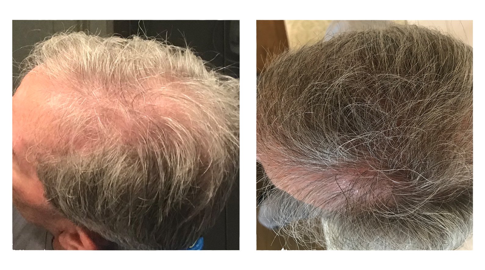 ER one month results