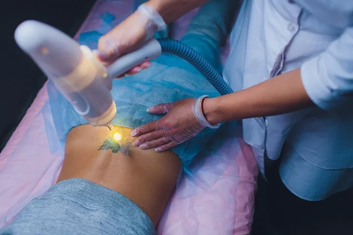 Tatueringsborttagning, 1 eller 3 tillfällen