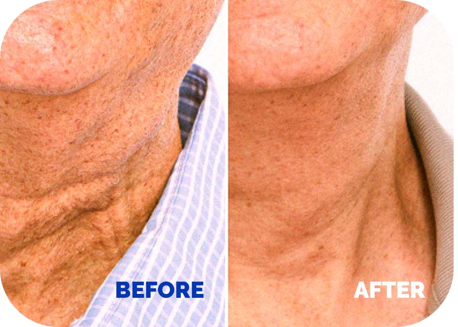 BEFORE AND AFTER APPLYING NECK CREAM