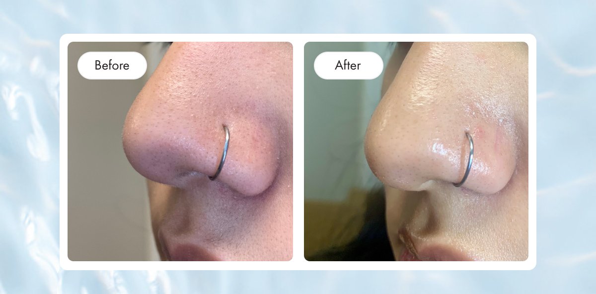 Nose Images Pore Release before and after