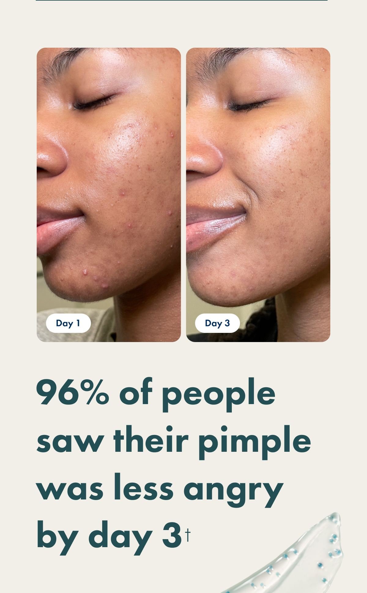 Before and after Pimple Correct image. 96% of people saw their pimple was less angry by day 3*