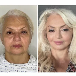 deep plane facelift