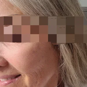 facial fat transfer
