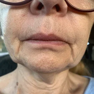 neck lift