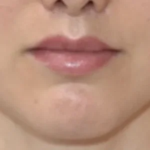 lip lift