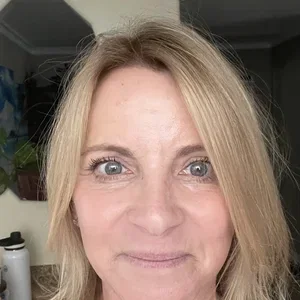 deep plane facelift