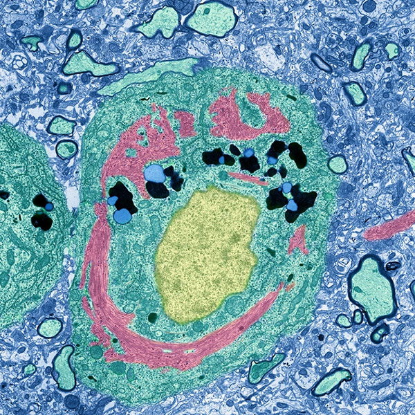 A coloured transmission electron micrograph of a neuron from a person with Alzheimer’s disease.