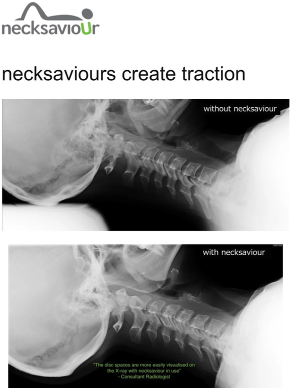 Neck traction