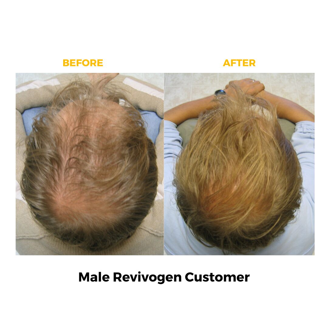 Before & After of Male Revivogen Customer with hair loss