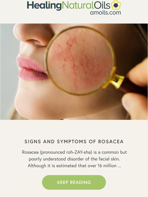 Signs and symptoms of Rosacea