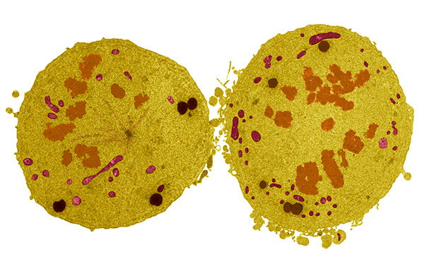 Coloured transmission electron micrograph (TEM) of a section through a cancer cell dividing by mitosis into two new daughter cells