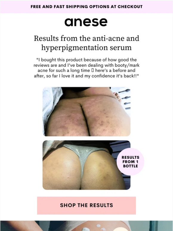 Results from our Booty Serum for Hyperpigmentation ✨