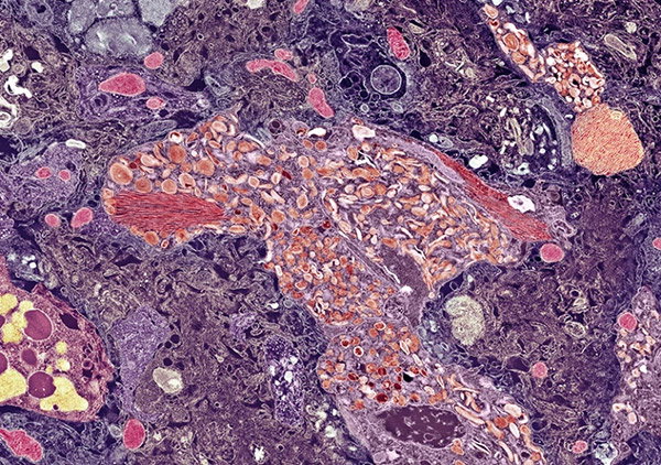 An electron microscope image shows a chaotic variety of cellular structure inside someone’s brain. The dye used to stain the cells means everything has a pink or purple hue.
