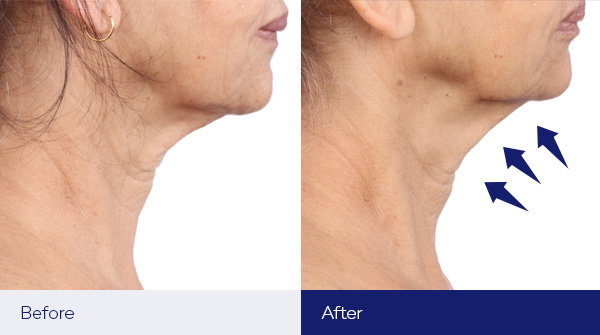 24% improvement in skin density in just 8 weeks
