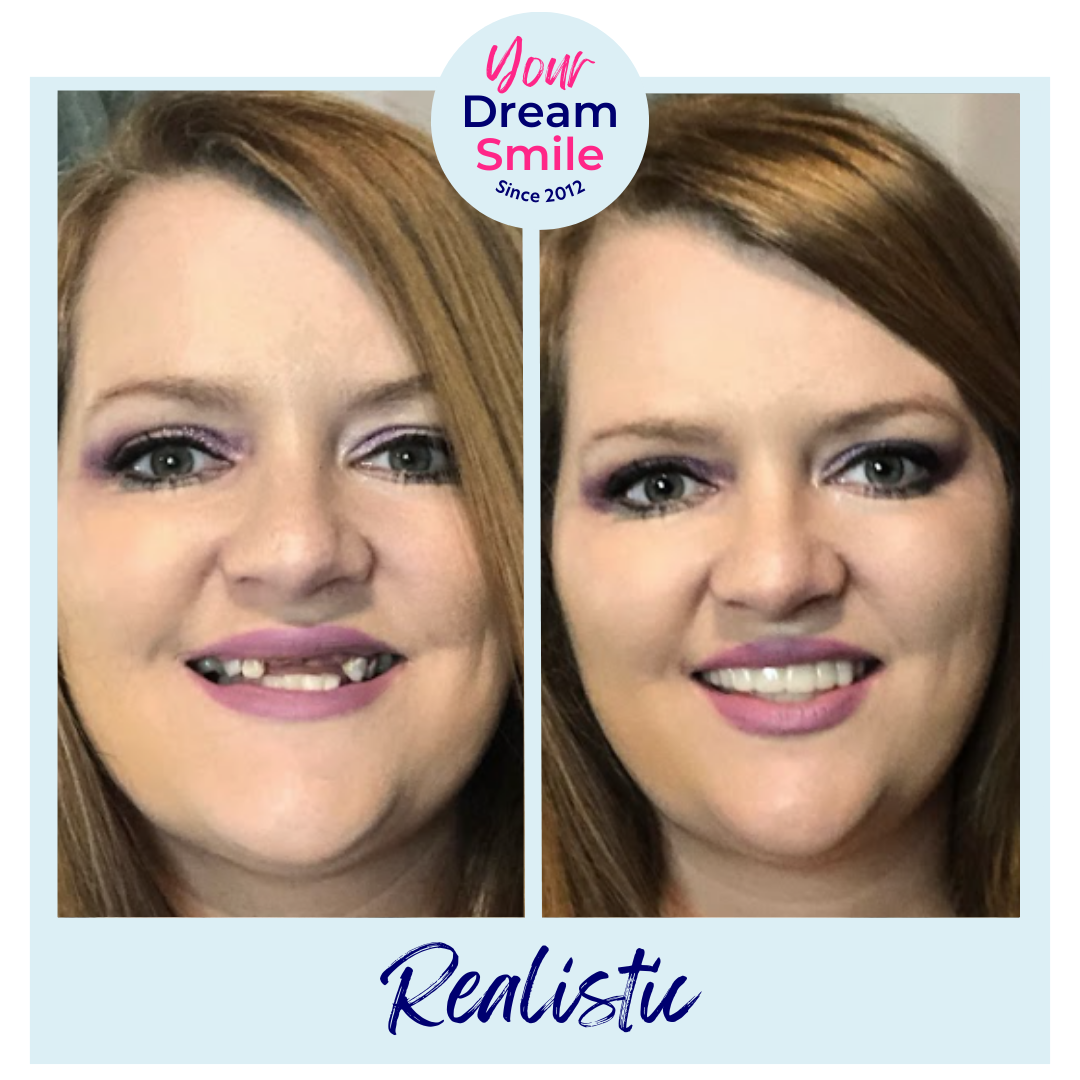 INSTAsmile (US) Hey —, 3 Reasons ClipOnVeneers are Perfect for