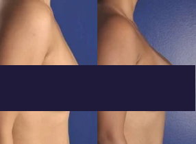 Breast lift before and after