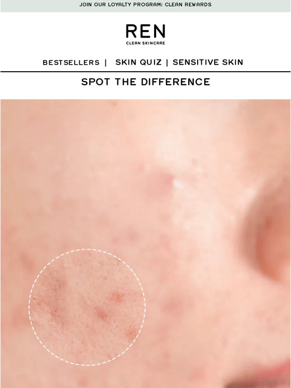 Say bye bye to breakouts 🖐