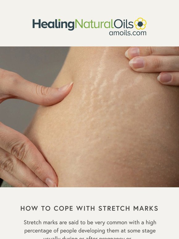 How To Cope With Stretch Marks