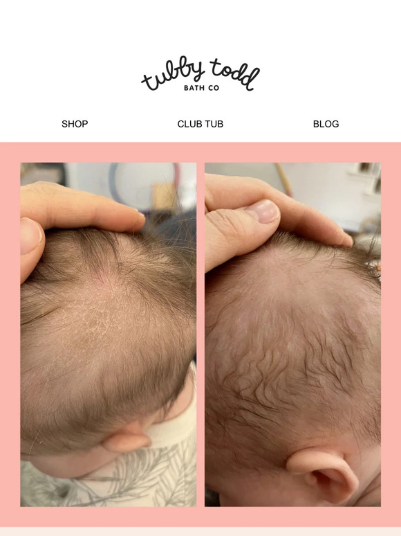 Got Cradle Cap?